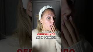 Прищі на все лице? Не дави!