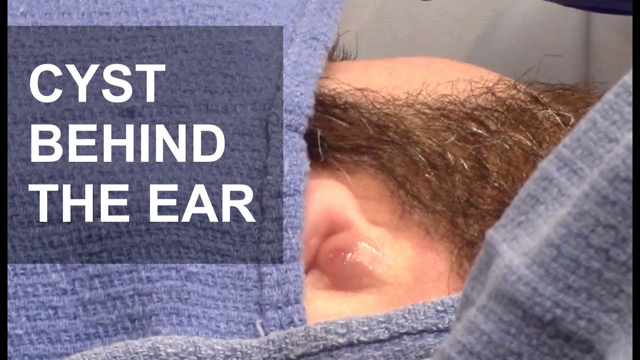 Cyst Drainage Behind The Ear Dr Derm Youtube