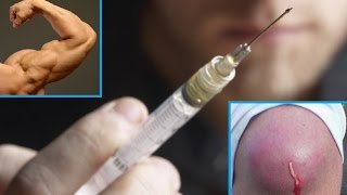 Постинъекционный абсцесс у спортсмена | Postinjection abscess of an athlete Постинъекционный абсцесс у спортсмена | Postinjection abscess of an athlete