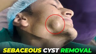 Secrets of Successful Sebaceous Cyst Removal | Awish Clinic | Sebaceous Cyst Remove | #viral