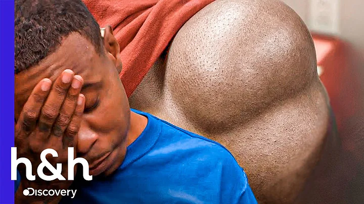 Nuevamente aparece enorme bulto en su espalda | Dr...
