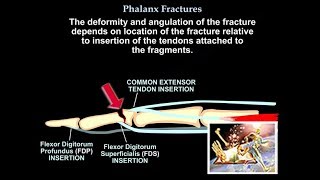 Phalanx Fractures - Everything You Need To Know - Dr. Nabil Ebraheim