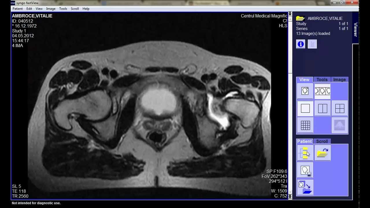 Остеопороз тазобедренного сустава - ПОМОГИТЕ - YouTube