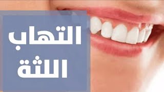 التهابات اللثة و علاجهاا سريعاا ‼