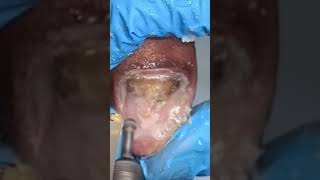 Severe Fungal Toenail#podiatry #footcare #fungaltoenails #treatment