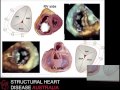 Echocardiographic assessment of the tricuspid valve - Dr Lisa Walters