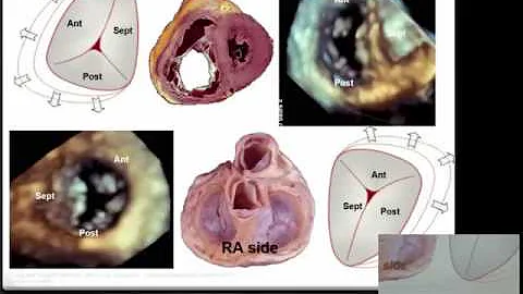 Echocardiographi...  assessment of the tricuspid v...