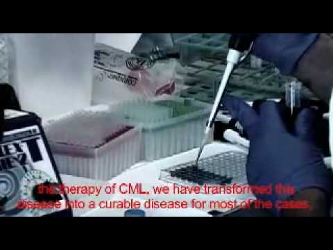 A new drug with a similar but more potent mechanism of action as imatinib, commonly known as Gleevec, appears to be more effective for the treatment of chronic myeloid leukemia, according to research published in the New England Journal of Medicine. Here is some information about chronic myeloid leukemia: â¢ Also known as CML, it is a slow progressing cancer found in the blood and bone marrow â¢ It results in the overgrowth of immature, malfunctioning white blood cells â¢ A major cause of CML is believed to be a genetic mutation that results in the development of an abnormal chromosome called BCR-ABL Researchers from the University of Turin treated nearly 850 patients suffering from CML with either a low dose or a high dose of a new drug known as nilotinib or with Gleevec. The patients were followed up for a year. At the end of the follow-up period, more than twice as many of the patients on nilotinib as on Gleevec experienced a major molecular response to their treatment, meaning the products of BCR-ABL were nearly undetectable in the blood. Similarly, more patients taking nilotinib than Gleevec had a complete cytogenic response, meaning cells containing the BCR-ABL mutation could not be detected in the blood or bone marrow. Those taking nilotinib were also less likely to experience a progression of their disease. We spoke with Dr. Giuseppe Saglio, one of the investigators of this study, who offered some further insight. Today's research suggests that a new, more powerful <b>...</b>