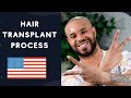 Our patient from america told about the hair transplant process esteticium