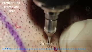 Extraction of Hair Follicles from the Donor Area