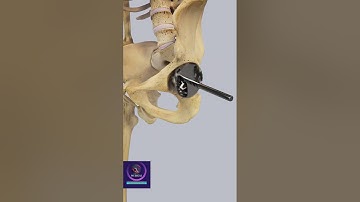 Total Hip Replacement -Orthopedic Surgery 3D Animation
