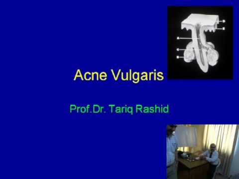 Management of Acne Vulgaris