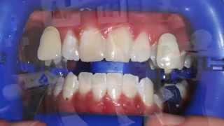 How Does Teeth Whitening Work? - Smile Design Studio screenshot 2