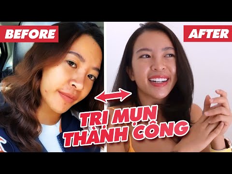 MÌNH ĐÃ SỐNG SÓT TRỞ VỀ SAU BREAKOUT | TRỊ MỤN THÀNH CÔNG ♡ Hana Giang Anh