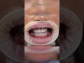 Primo Dental Veneer Smile Before/After #shorts
