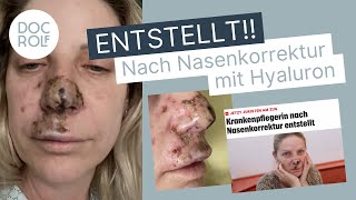 NASENKORREKTUR OHNE OP - Wienerin entstellt 😱 - Dr. Rolf Bartsch