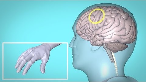 Repetitive Transcranial Magnetic Stimulation (rTMS) and Hand Therapy
