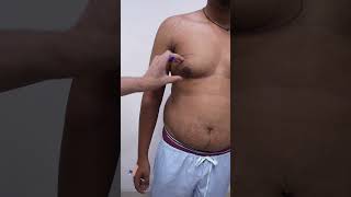 Gynecomastia marking & Planning before Surgery short viralshort