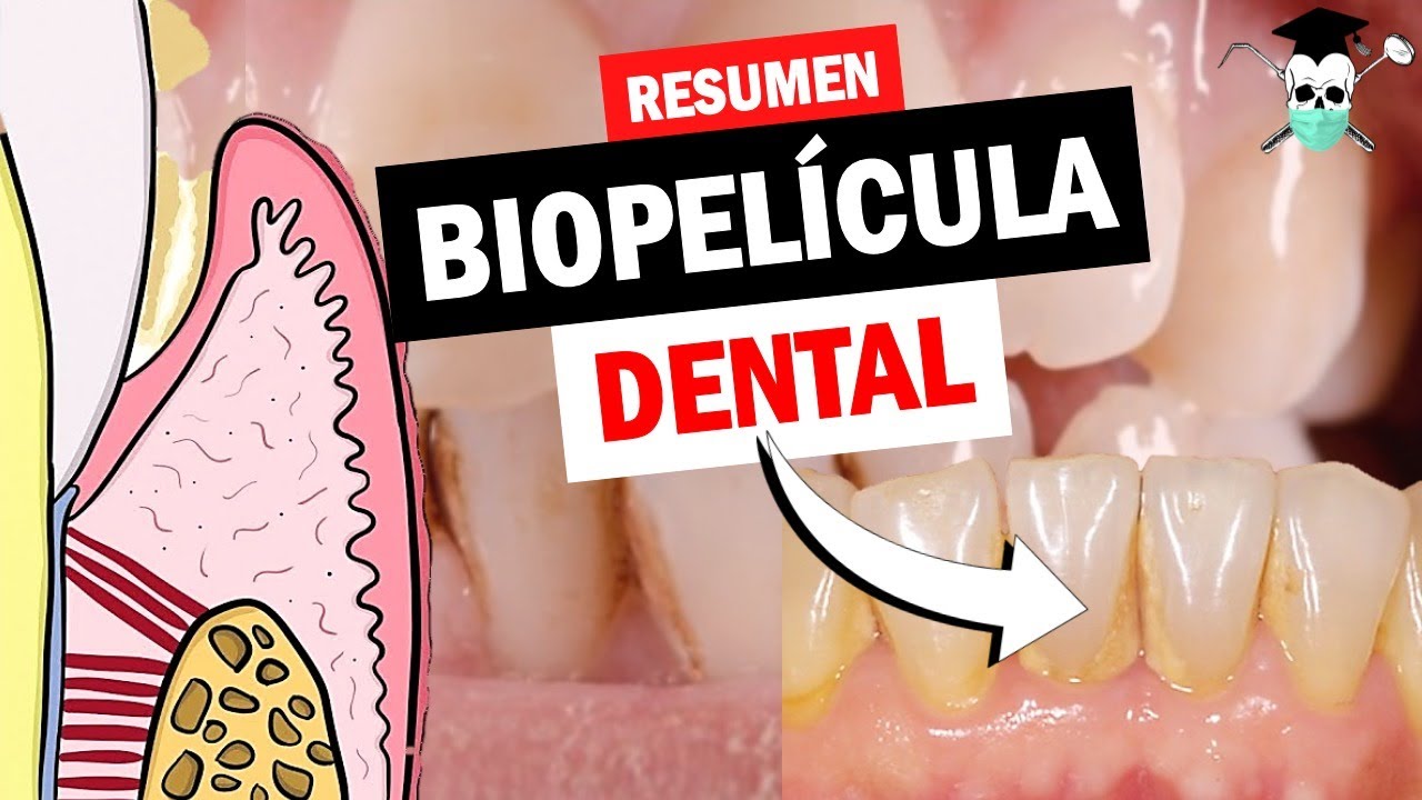 ¿Qué es la PLACA DENTAL, BIOFILM o BIOPELICULA? *Pirámide de Socransky
