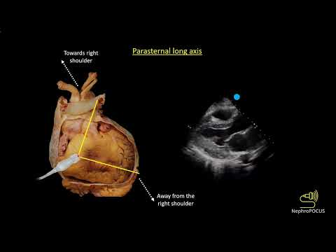 Image of Basic cardiac ultrasound views I Dr. Koratala @NephroP