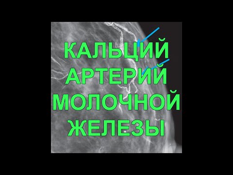 Видео: Кальцификация молочных желез: причины, признаки и многое другое