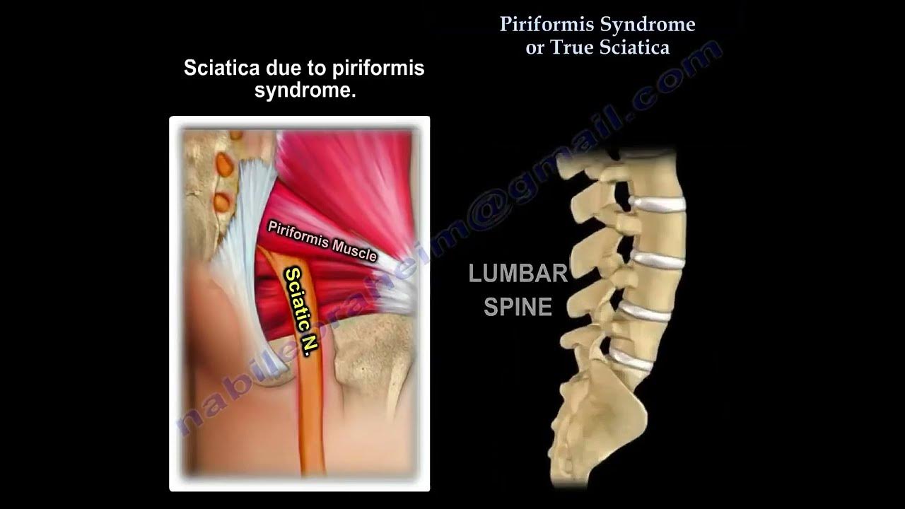 Piriformis syndrome 