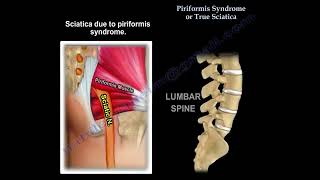 Piriformis syndrome  or disc herniation, how do you tell the difference ? a confusing presentation