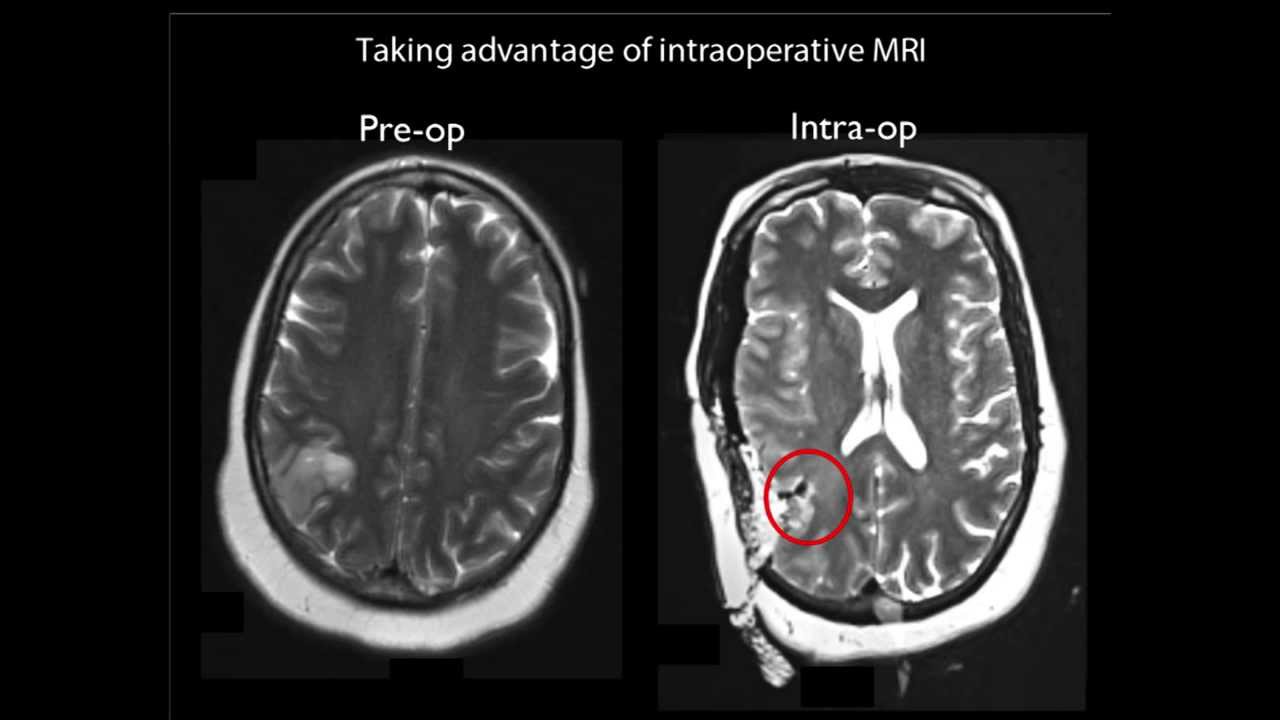 Treating Brain Tumors with Intraoperative MRI (iMRI) - Highlights from