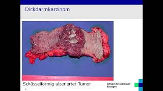 Pathologie und Molekularpathologie des kolorektalen Karzinoms Prof. Dr. med. Arndt Hartmann