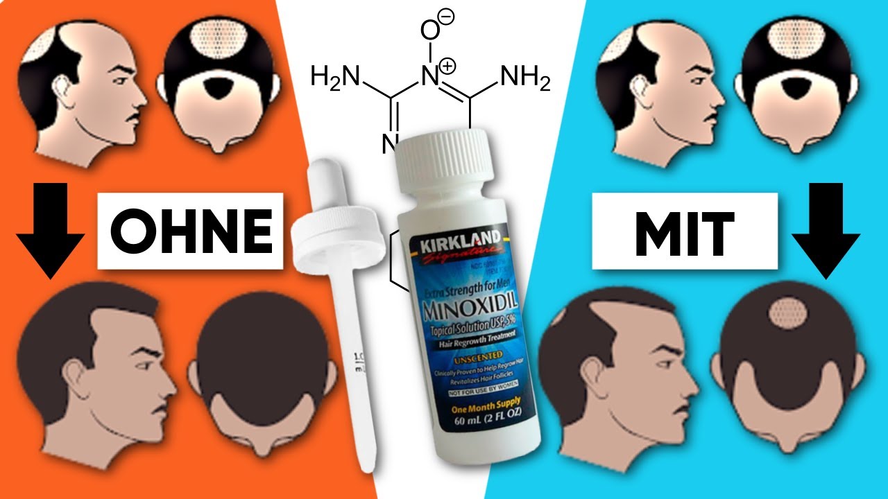 Der Einfluss von Minoxidil auf die Haartransplantation | So kriegst du ein besseres HT Ergebnis ...