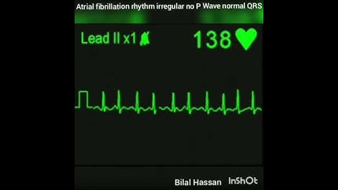 Atrial fibrillation ECG Simulation