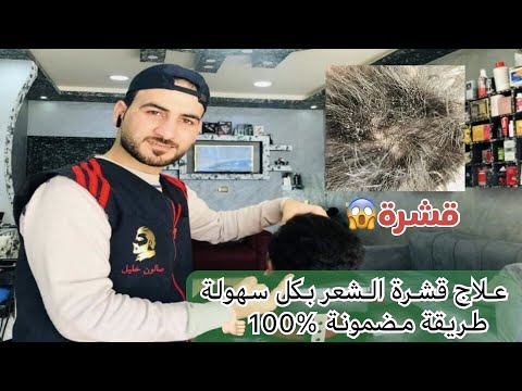 وداعاً للقشرة , طريقة ازالة القشرة الدهنية بشكل نهائي من الراس وبكل سهولة