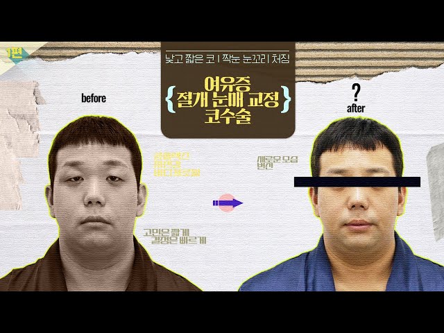[Vlog] 피곤한 눈, 움츠러드는 가슴, 낮은 코로부터 모든 게 바뀌었어요~  ⭐수술 전과 후⭐ #여유증 #절개눈매교정 #코수술