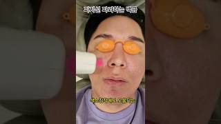 백금이 피지선을 파괴해서 피지와 여드름 예방#무통증#여드름치료