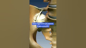 Stabilizing the SI Joint prevents inflammation