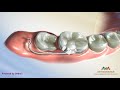 Orthodontic treatment for molar uprighting  halterman appliance