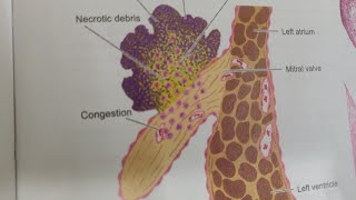 INFECTIVE ENDOCARDITIS HANDWRITTEN NOTES, ETIOLOGY, MORPHOLOGY, CLINICAL DIAGNOSIS