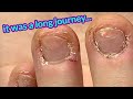 Bitten Nails Transformation - 2 years later! Anna's Last fill 😢