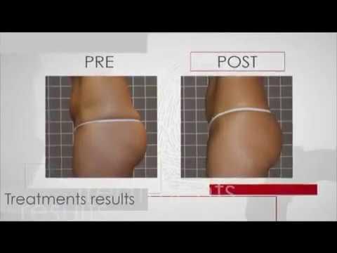 Icoone laser отзывы реальные до и после
