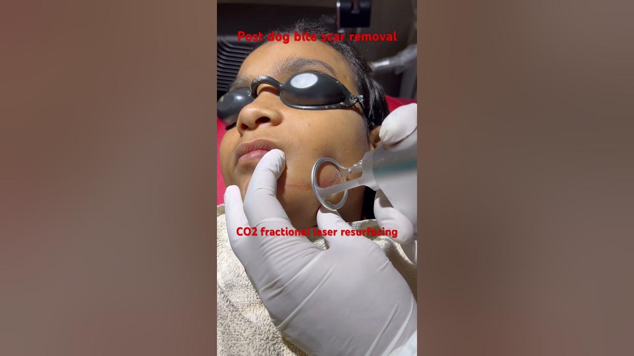 post-dog-bite-scar-removal-co2fractionallaser-resurfacing