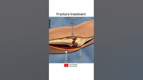 Hand bone fracture treatment | 3D animation