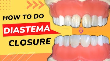 Space between front teeth | Front wing technique Diastema Closure | your dentist #directrestoration