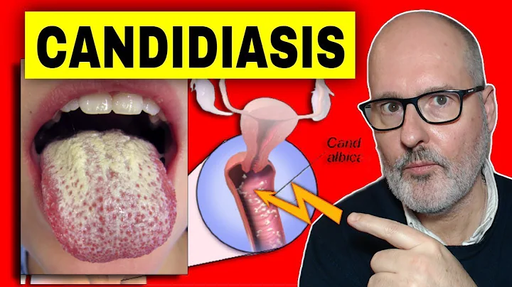 What is CANDIDA and how is CANDIDIASIS CURED?