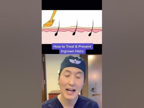 How to Prevent & Treat Ingrown Hairs! #shorts #ingrownhair 
