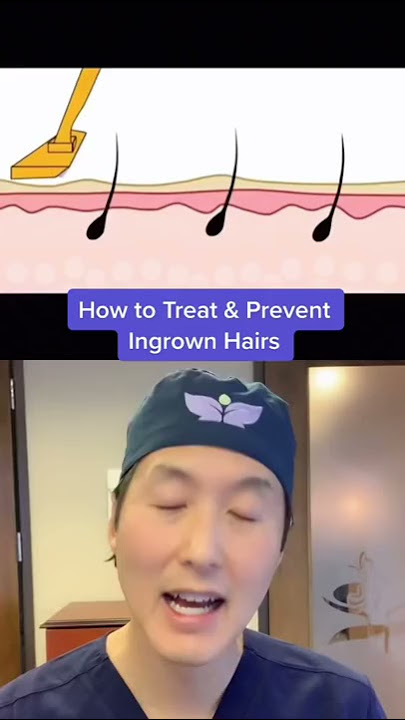 How to Prevent & Treat Ingrown Hairs! #shorts #ingrownhair