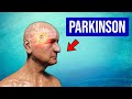 Maladie de parkinson  explication symptmes et traitements