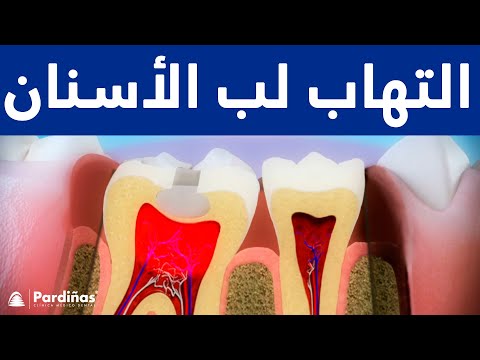 التهاب لب الأسنان ©