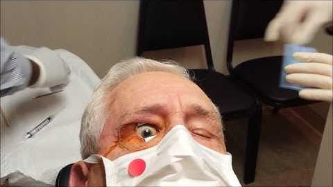 Intravitreal Injection of Anti-VEGF