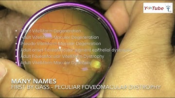 Adult Vitelliform Lesions - Dr. Anuj Soni