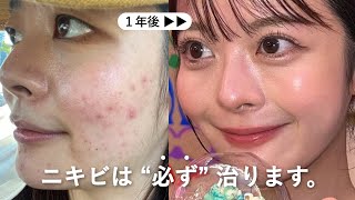 本気で治したい人だけ見て。ニキビ地獄から､毛穴ゼロ＆たまご肌になった5つの方法🥚